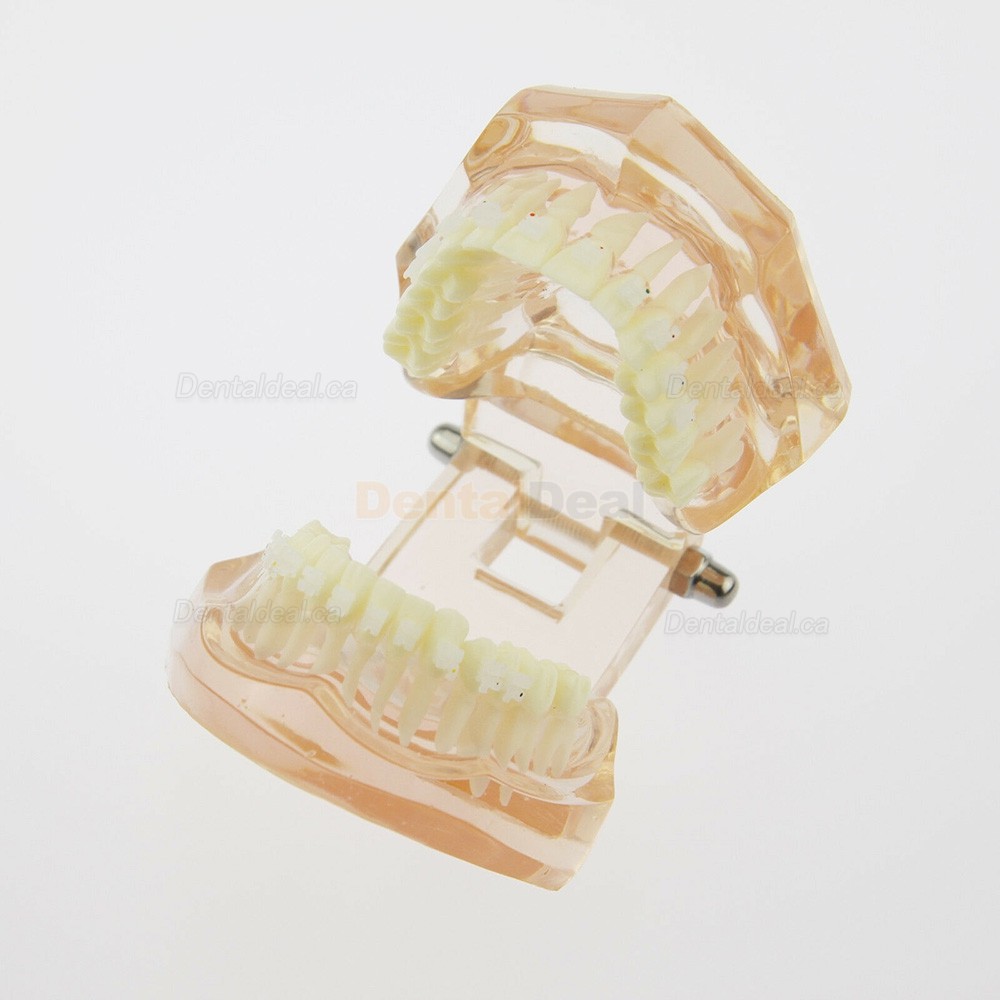 Dental Orthodontic Model with Metal Ceramic Brackets Demo Study Model 3002