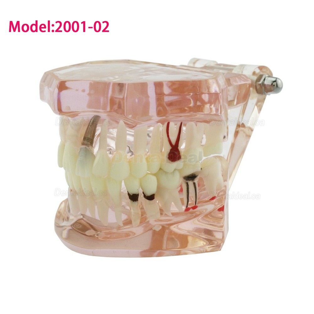 Dental Teething Implant and Restoration Model Implant Demo Caries Model