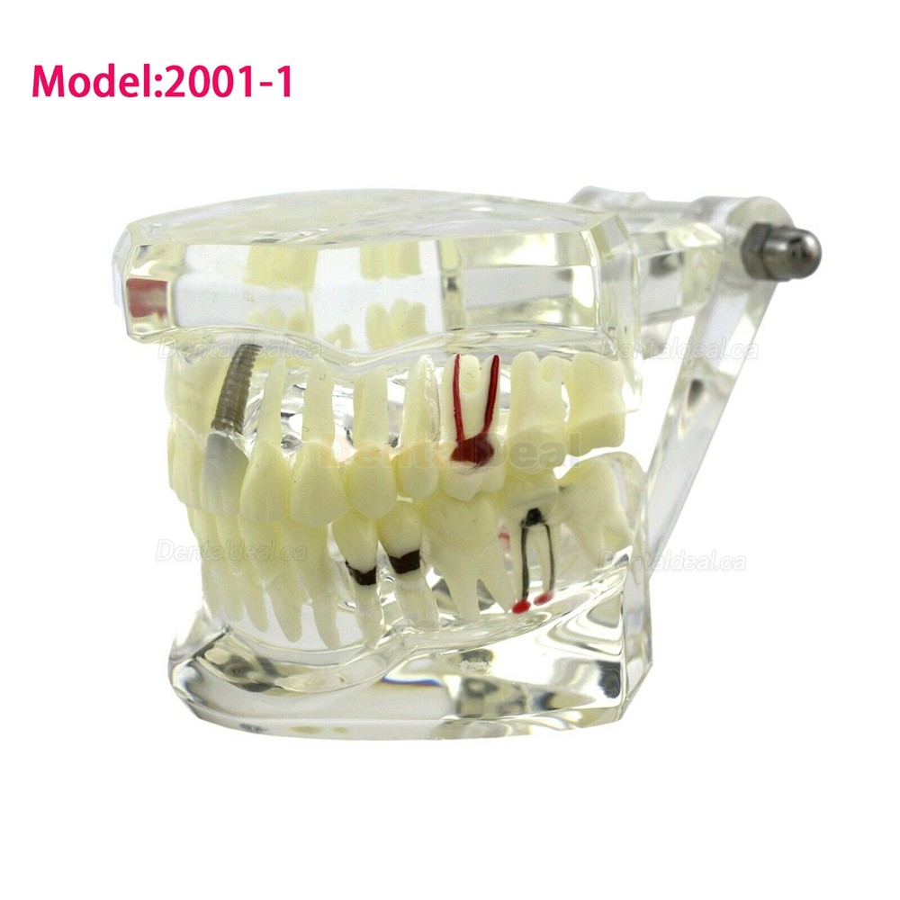 Dental Teething Implant and Restoration Model Implant Demo Caries Model