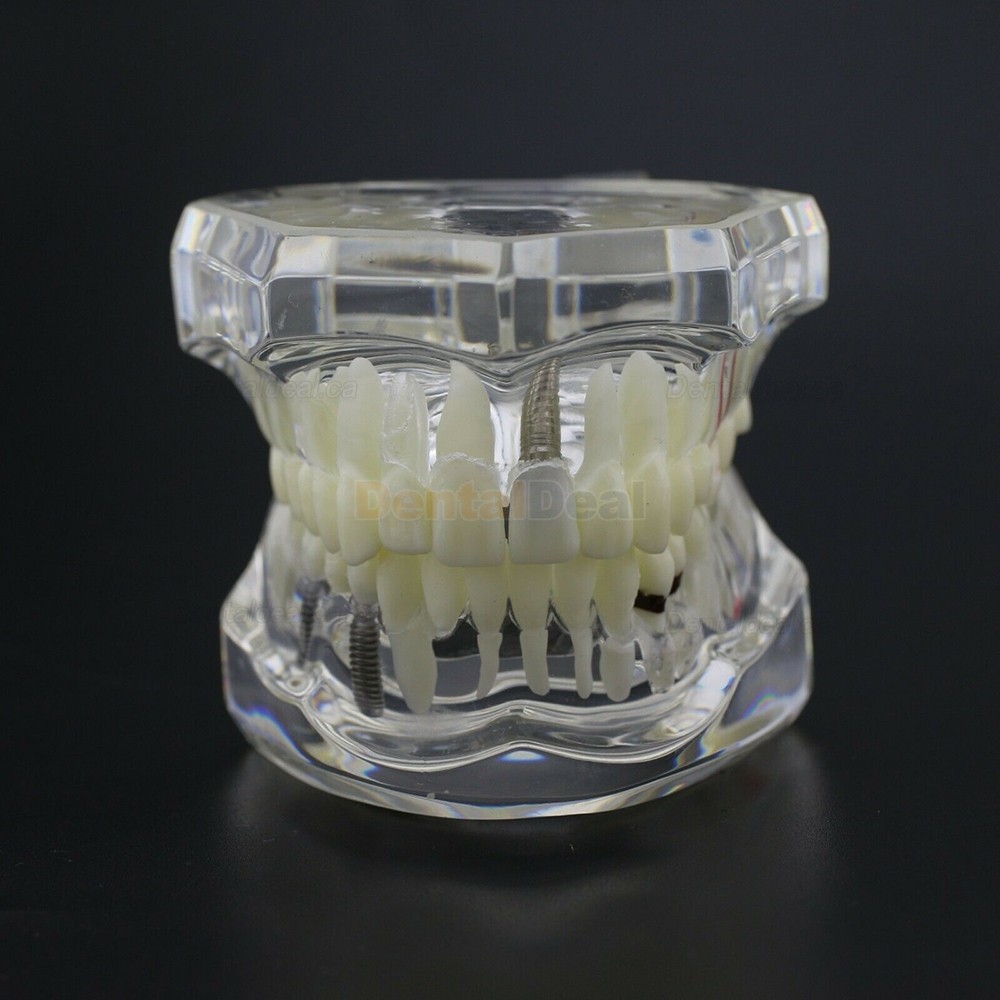 Dental Teething Implant and Restoration Model Implant Demo Caries Model