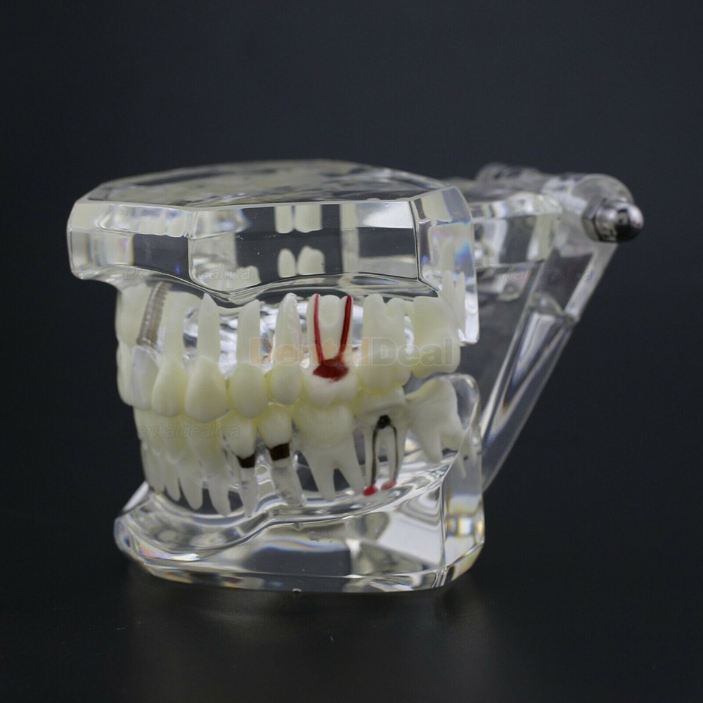 Dental Teething Implant and Restoration Model Implant Demo Caries Model