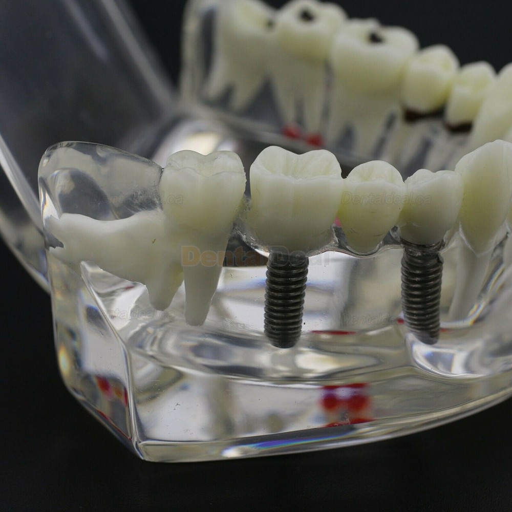 Dental Teething Implant and Restoration Model Implant Demo Caries Model