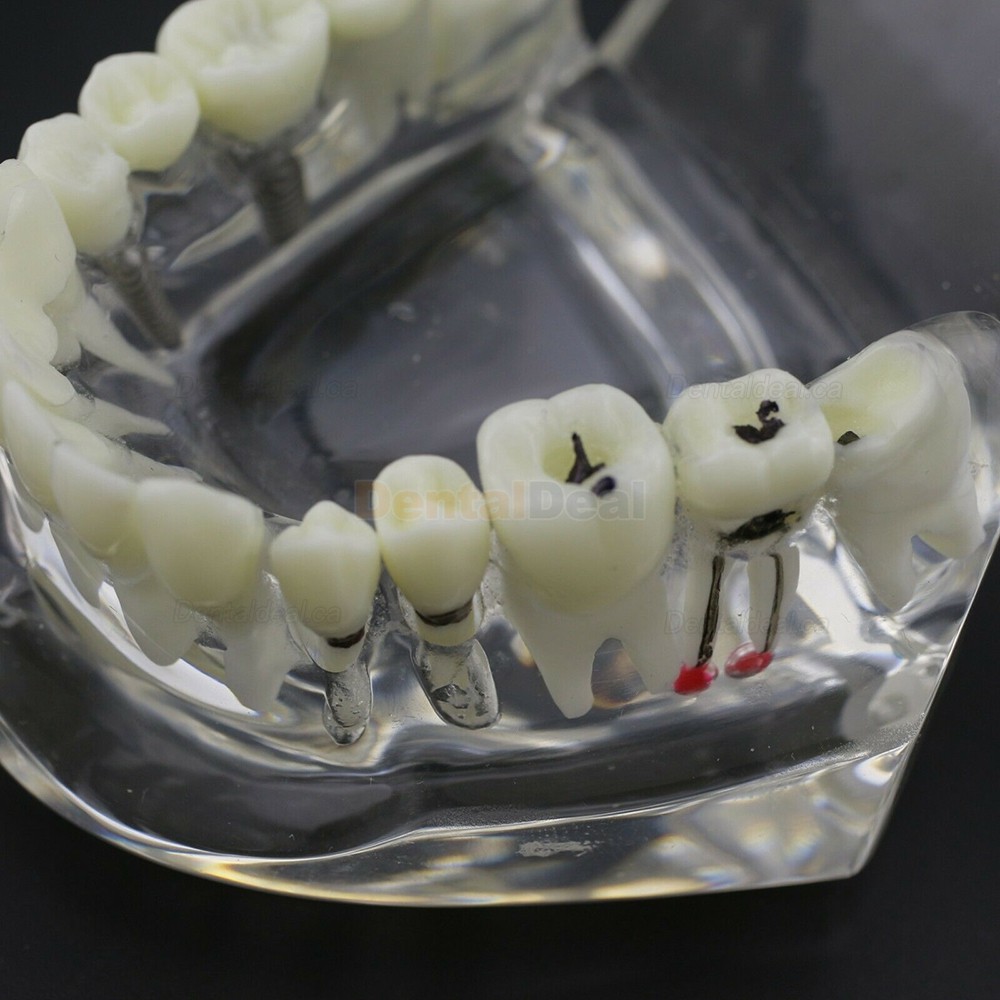 Dental Teething Implant and Restoration Model Implant Demo Caries Model
