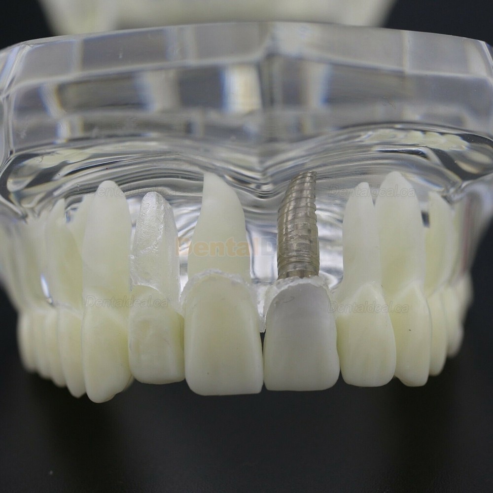 Dental Teething Implant and Restoration Model Implant Demo Caries Model