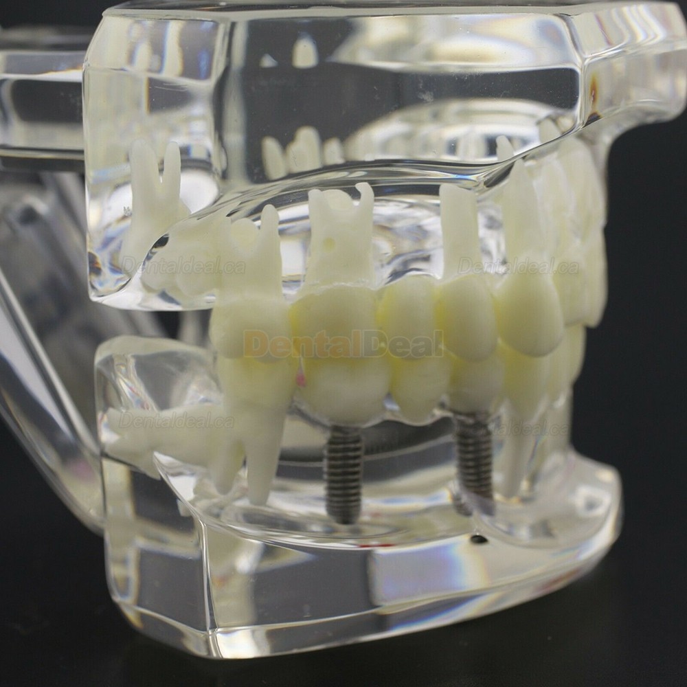 Dental Teething Implant and Restoration Model Implant Demo Caries Model