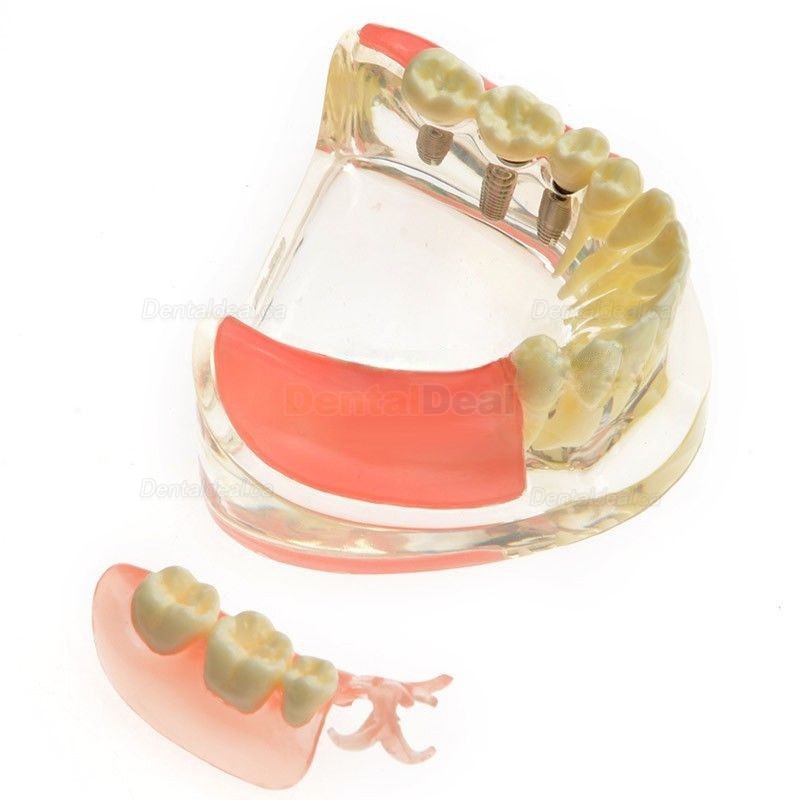 M-6006 Dental Study Training Model Contrast Implant Restoration for Missing Molar Teeth
