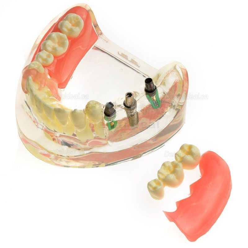 M-6006 Dental Study Training Model Contrast Implant Restoration for Missing Molar Teeth