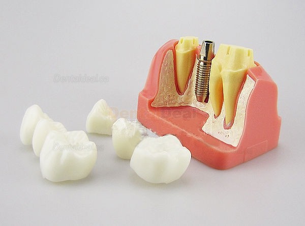Dental Implant Demo Training Model for Students Patients M2017