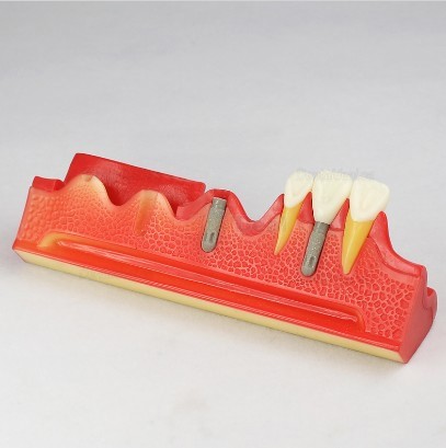 Dental Implant Demonstration Model for Patient Education M2018