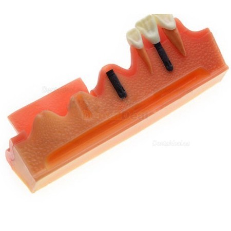 Dental Implant Demonstration Model for Patient Education M2018