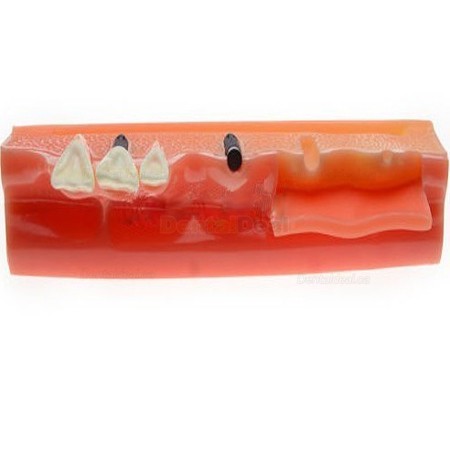 Dental Implant Demonstration Model for Patient Education M2018