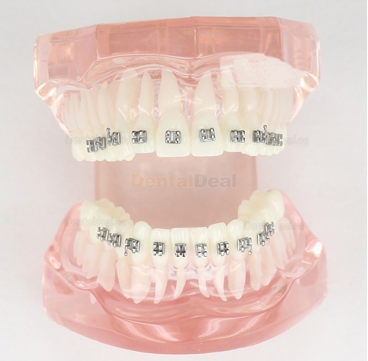 Dental Teeth Demo Model With Metal Bracket for Patient Education M3001