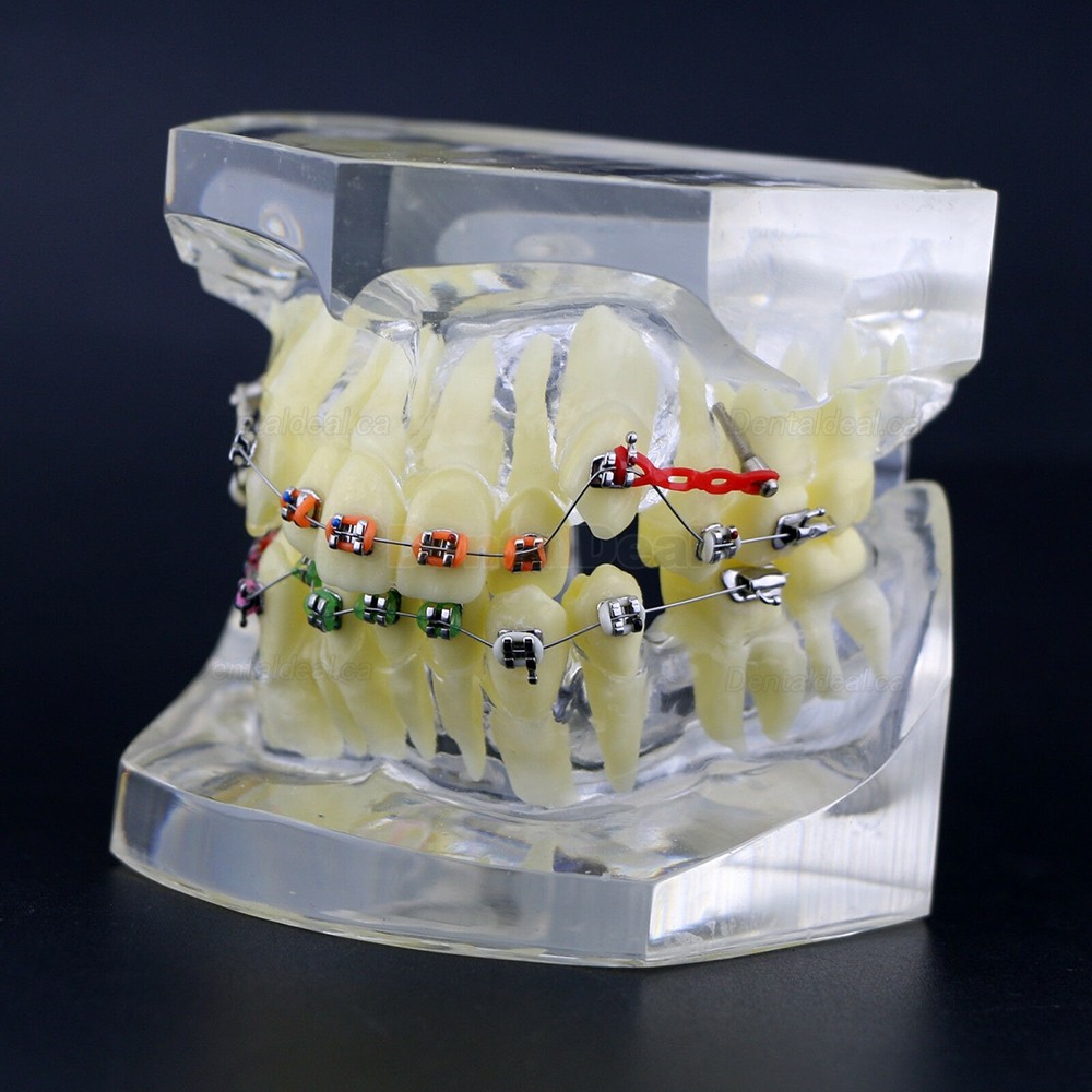 Dental Orthodontic Typodont Study Training Model With Metal Brackets
