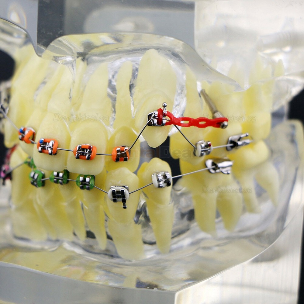Dental Orthodontic Typodont Study Training Model With Metal Brackets