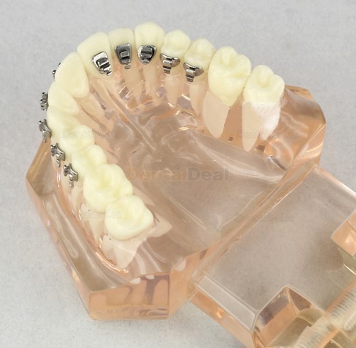 Dental Orthodontic Typodont Study Model with Ceramic Brackets M3009