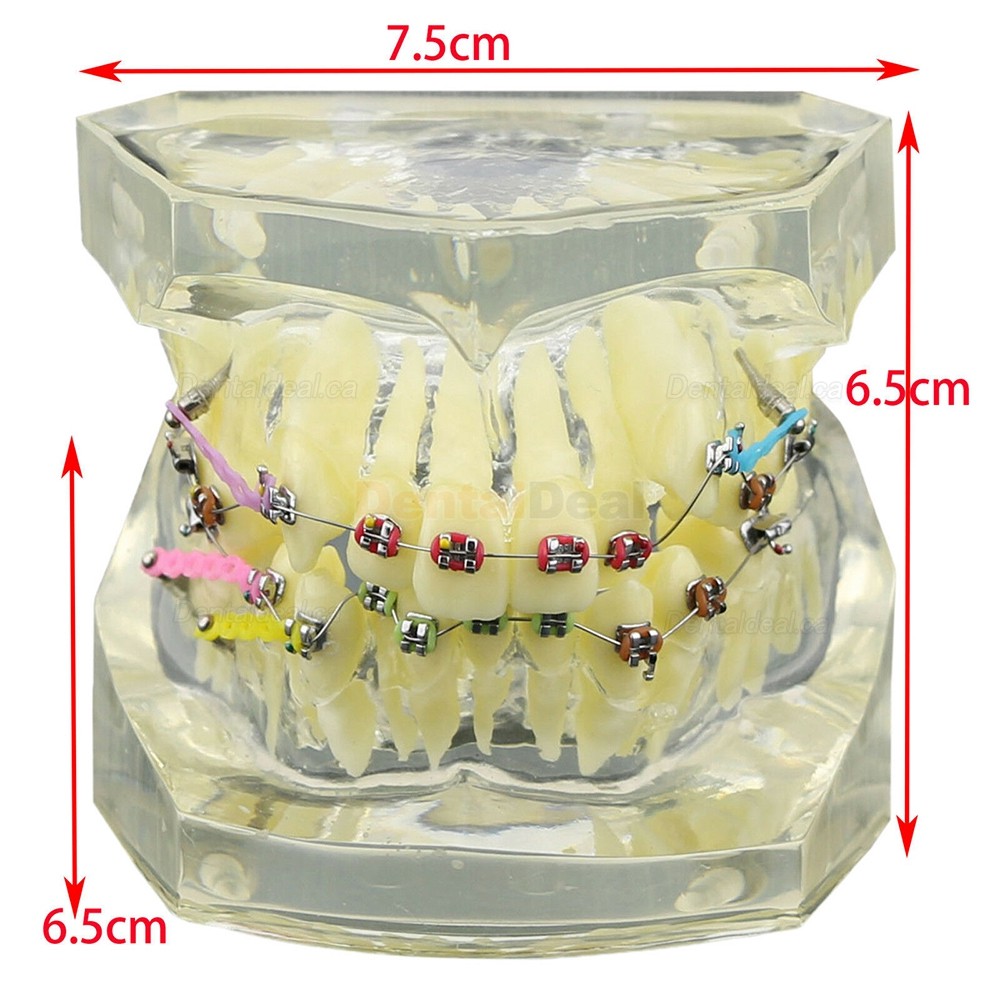 Dental Orthodontic Teeth Model with Metal Ceramic Bracket Tube Self-ligating Chain