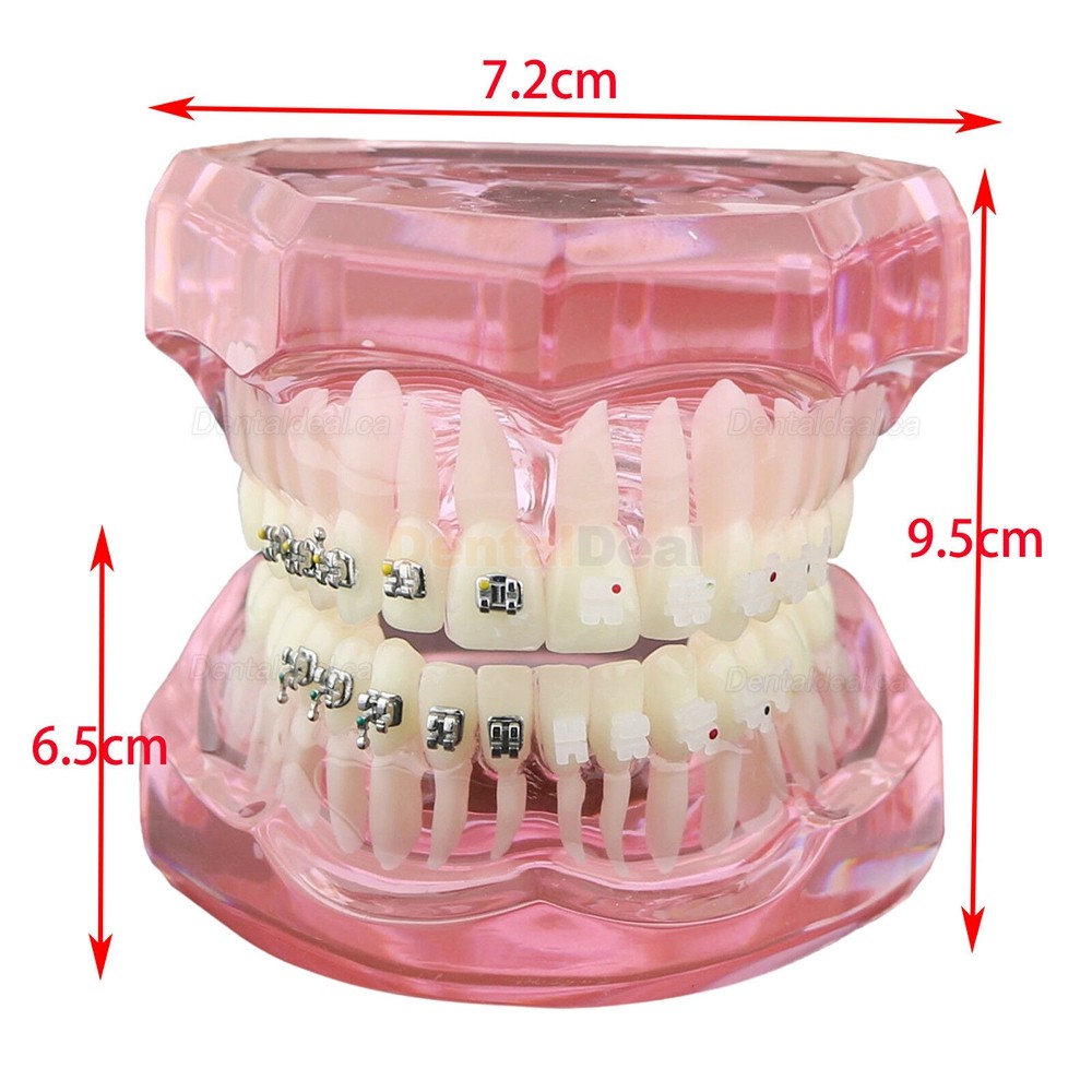 Dental Orthodontic Teeth Model with Metal Ceramic Bracket Tube Self-ligating Chain
