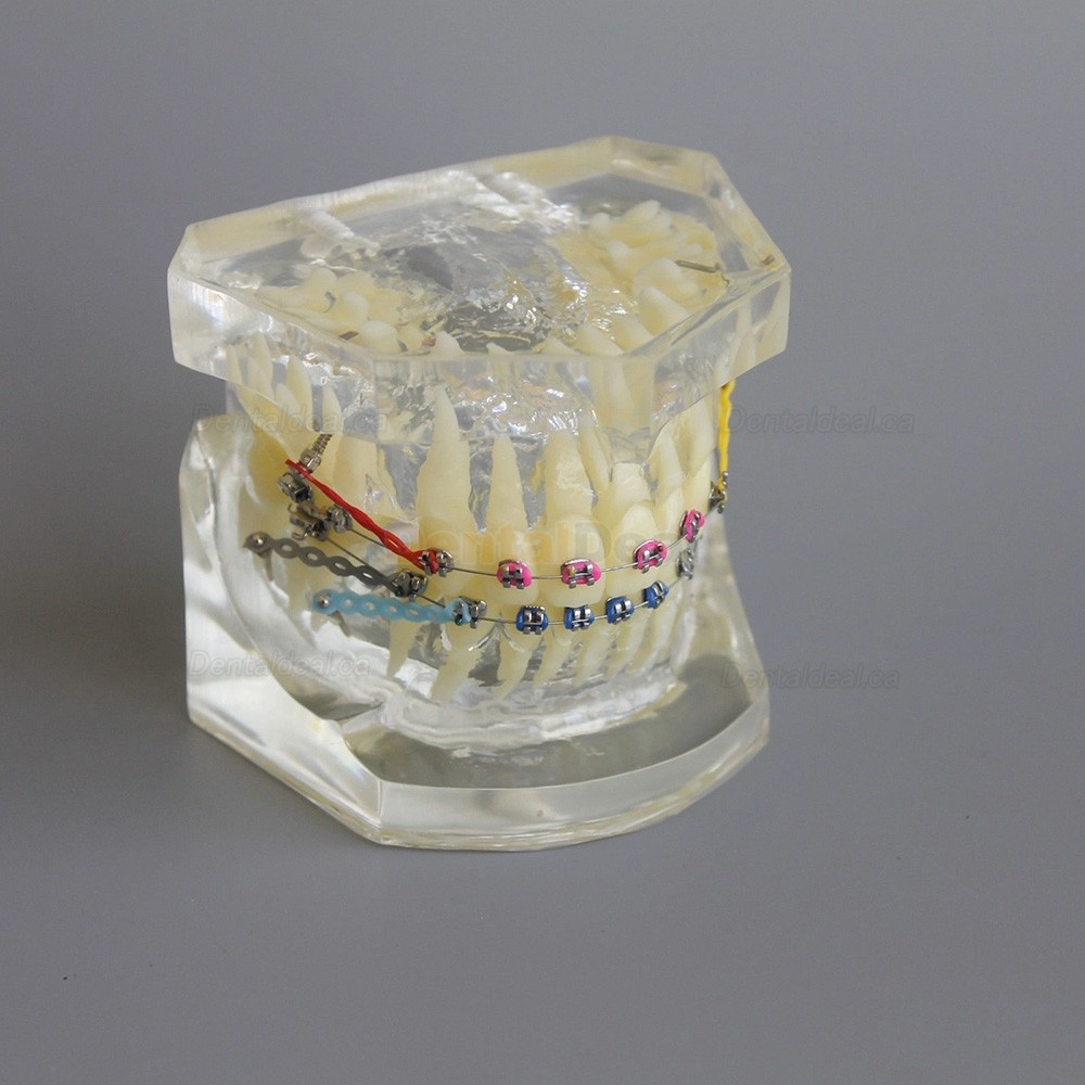 Dental Typodont Model Orthodontic Demonstration Practice Model With Metal Bracket Archwire