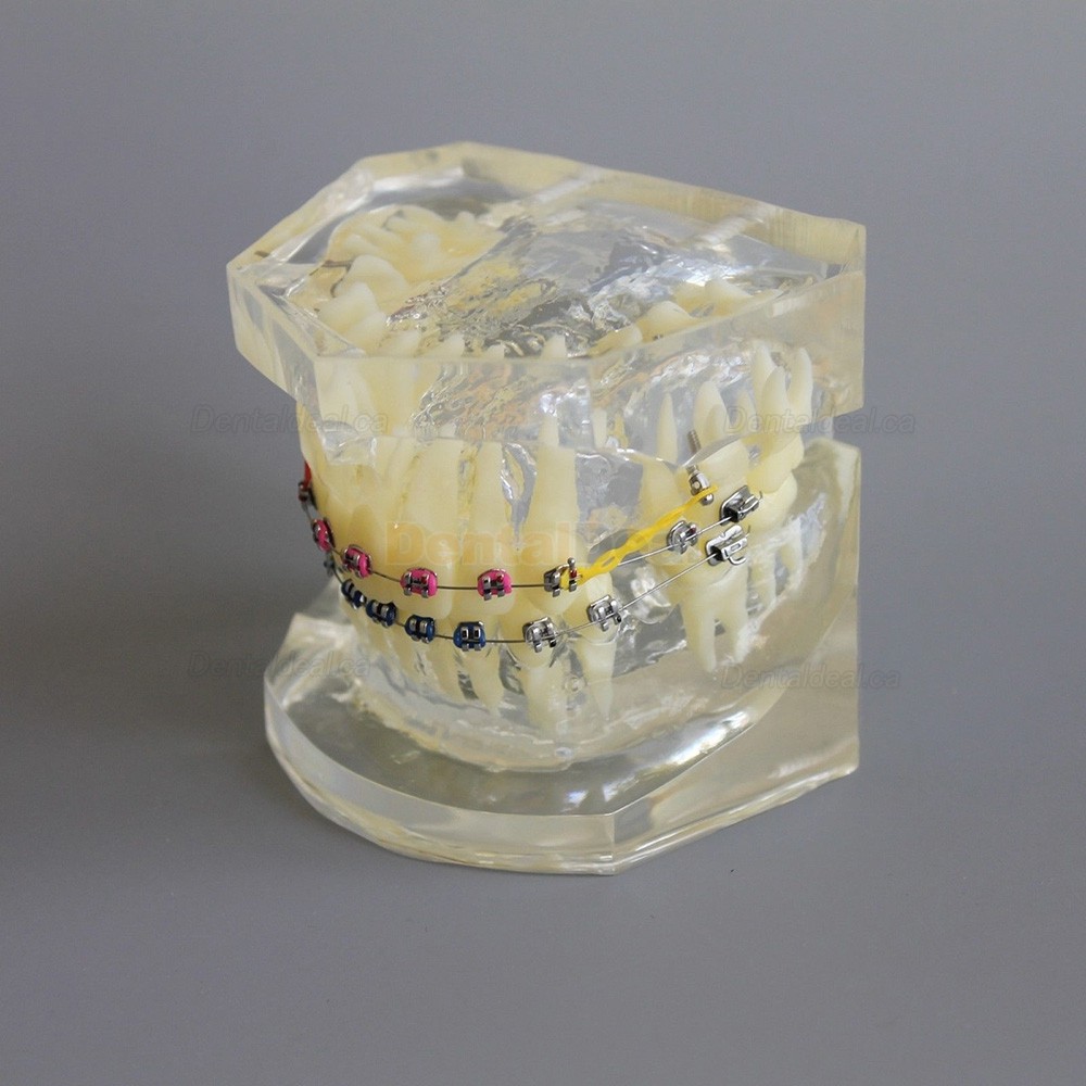 Dental Typodont Model Orthodontic Demonstration Practice Model With Metal Bracket Archwire