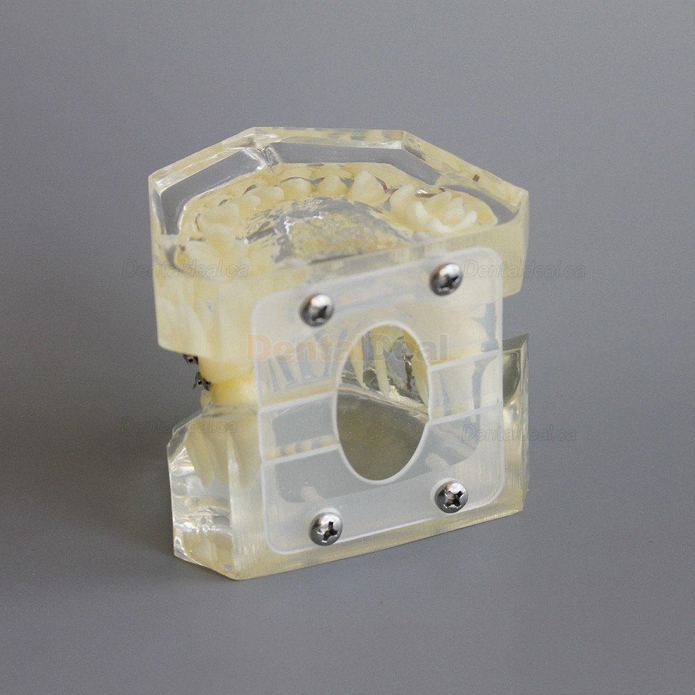 Dental Typodont Model Orthodontic Demonstration Practice Model With Metal Bracket Archwire