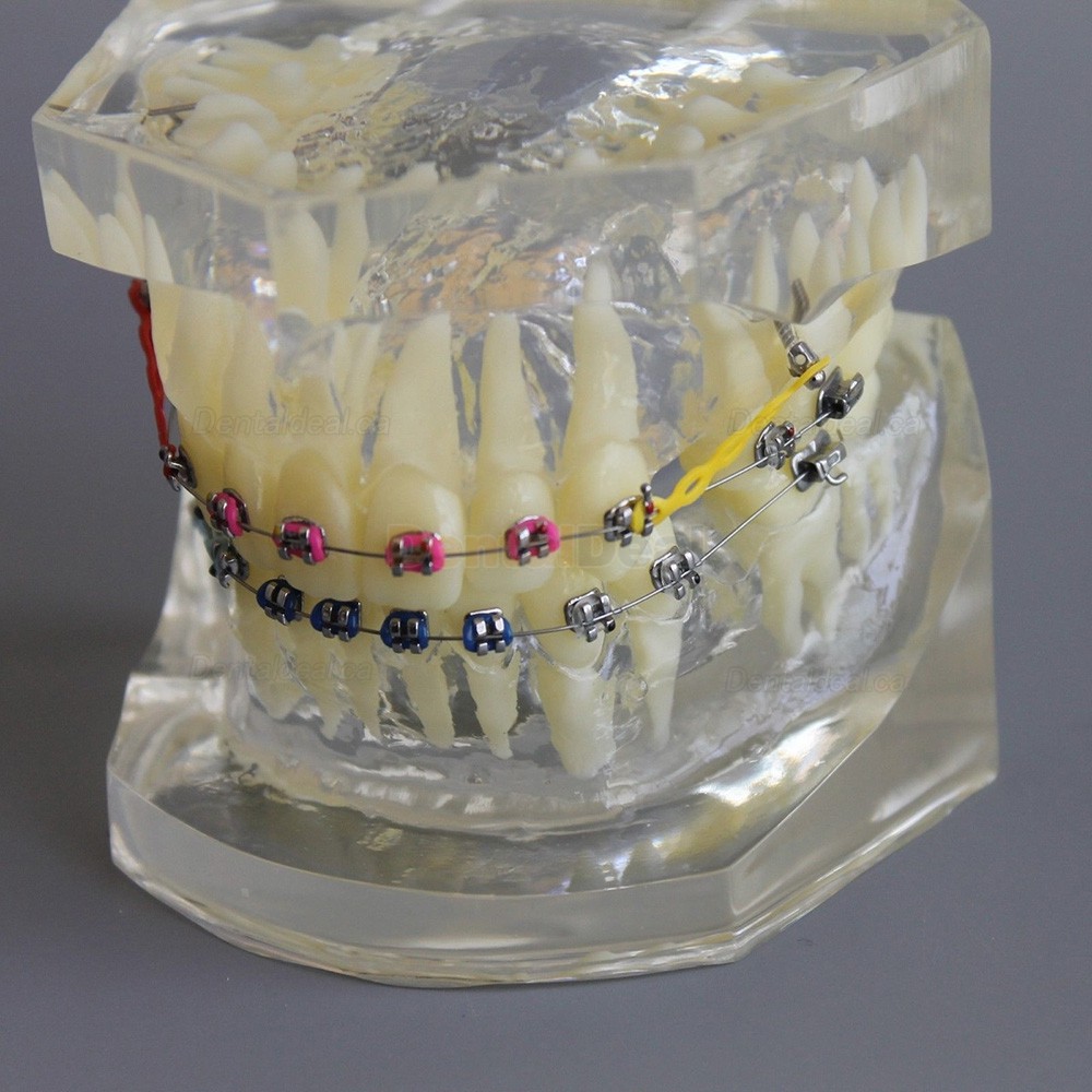 Dental Typodont Model Orthodontic Demonstration Practice Model With Metal Bracket Archwire