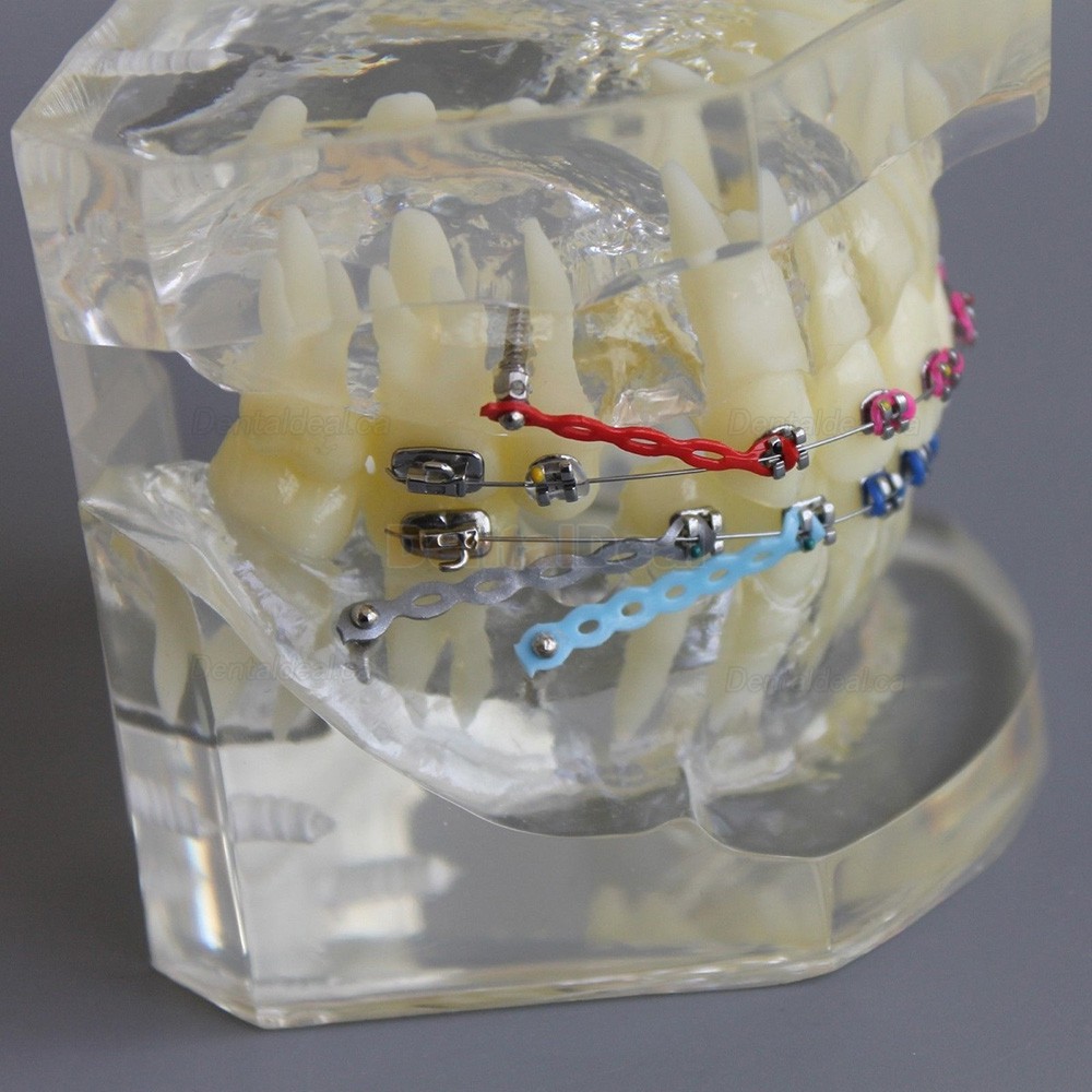 Dental Typodont Model Orthodontic Demonstration Practice Model With Metal Bracket Archwire