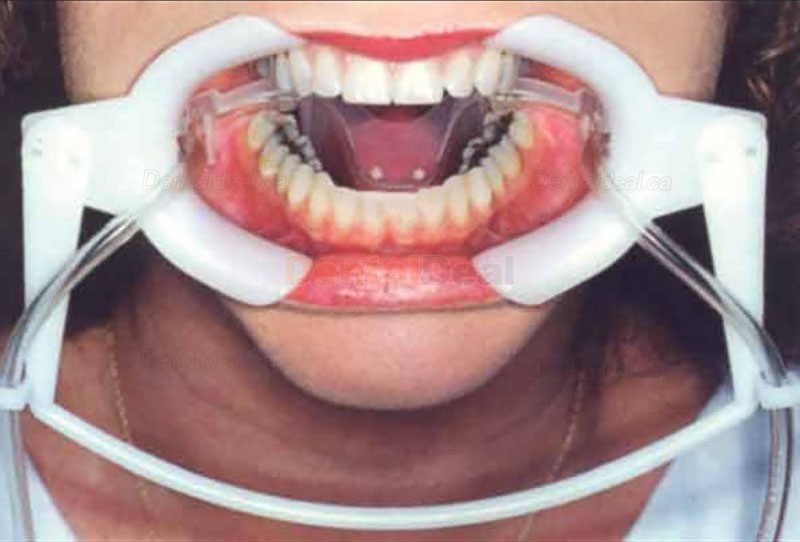Dental Retractor with Saliva Suction Tube Intraoral Lip Mouth Opener