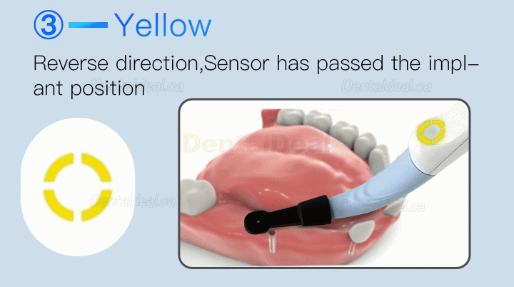 Dental Implant Locator Smart Implant Finder Implant Detector Three-dimesonal Sensor