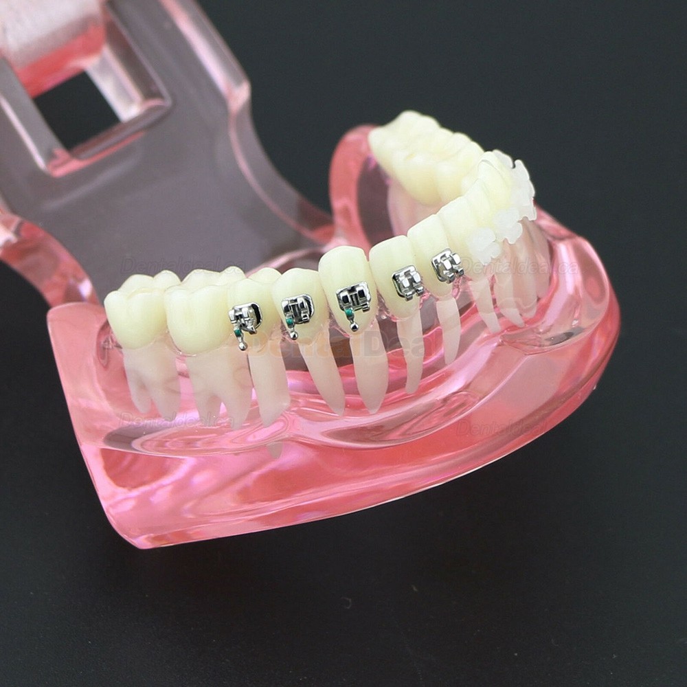Orthodontic Teeth Model with Metal and Ceramic Bracket Braces Dental Study Training Model 3003