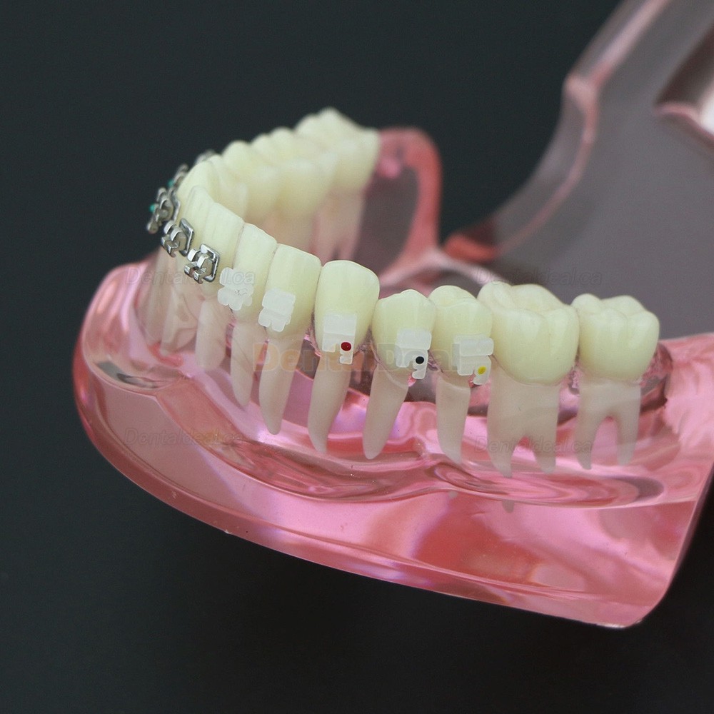 Orthodontic Teeth Model with Metal and Ceramic Bracket Braces Dental Study Training Model 3003