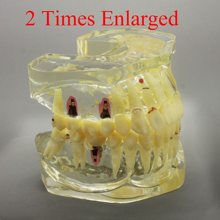 2 Times Enlarged Dental Implant Study Training Demo Model with Bridge