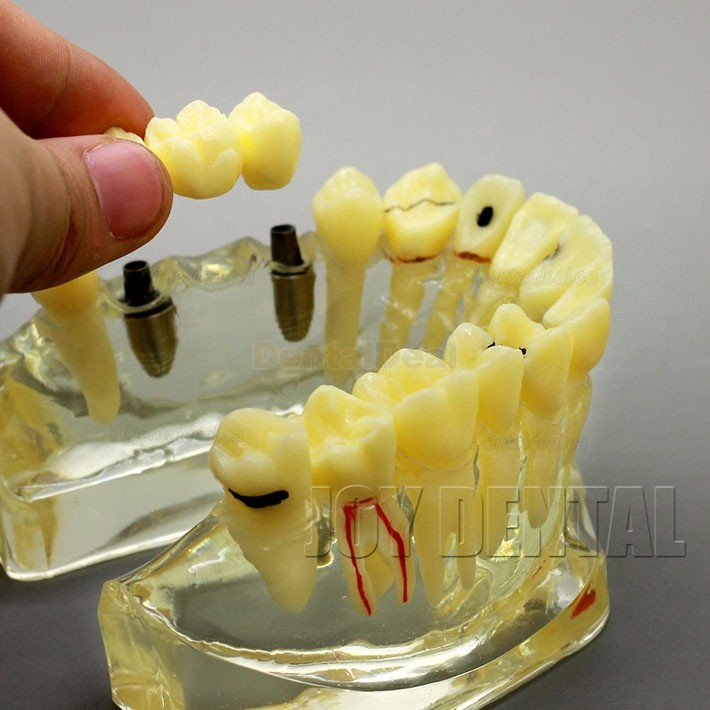 2 Times Enlarged Dental Implant Study Training Demo Model with Bridge