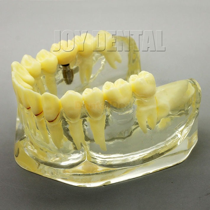 2 Times Enlarged Dental Implant Study Training Demo Model with Bridge