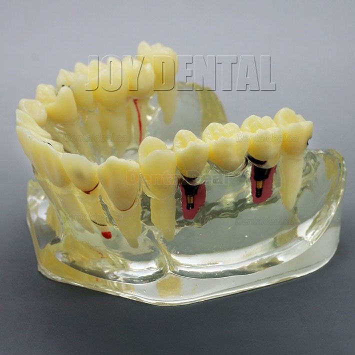 2 Times Enlarged Dental Implant Study Training Demo Model with Bridge