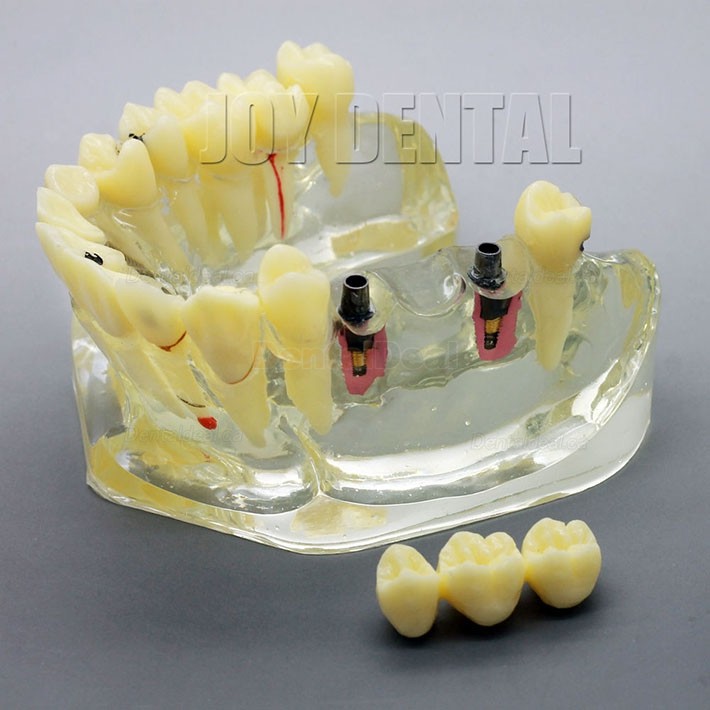 2 Times Enlarged Dental Implant Study Training Demo Model with Bridge