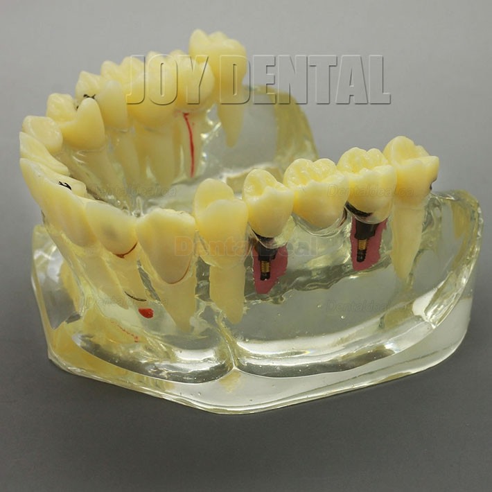 2 Times Enlarged Dental Implant Study Training Demo Model with Bridge