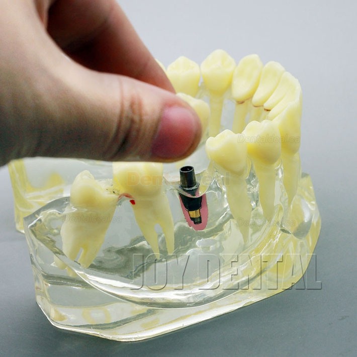 2 Times Enlarged Dental Implant Study Training Demo Model with Bridge