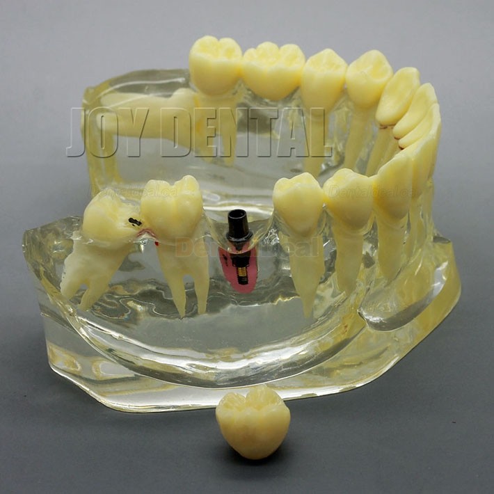 2 Times Enlarged Dental Implant Study Training Demo Model with Bridge