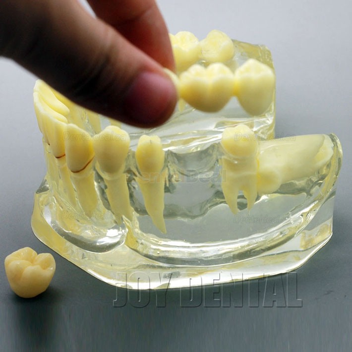 2 Times Enlarged Dental Implant Study Training Demo Model with Bridge