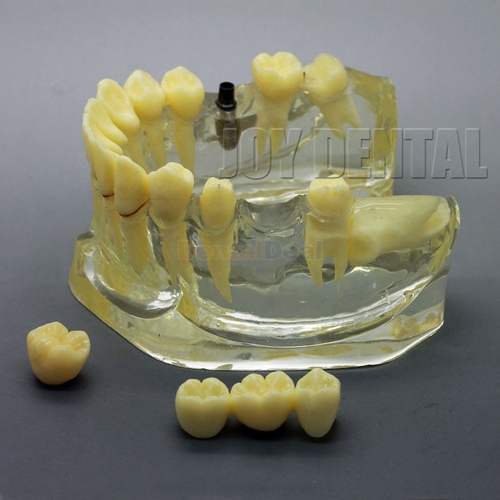 2 Times Enlarged Dental Implant Study Training Demo Model with Bridge