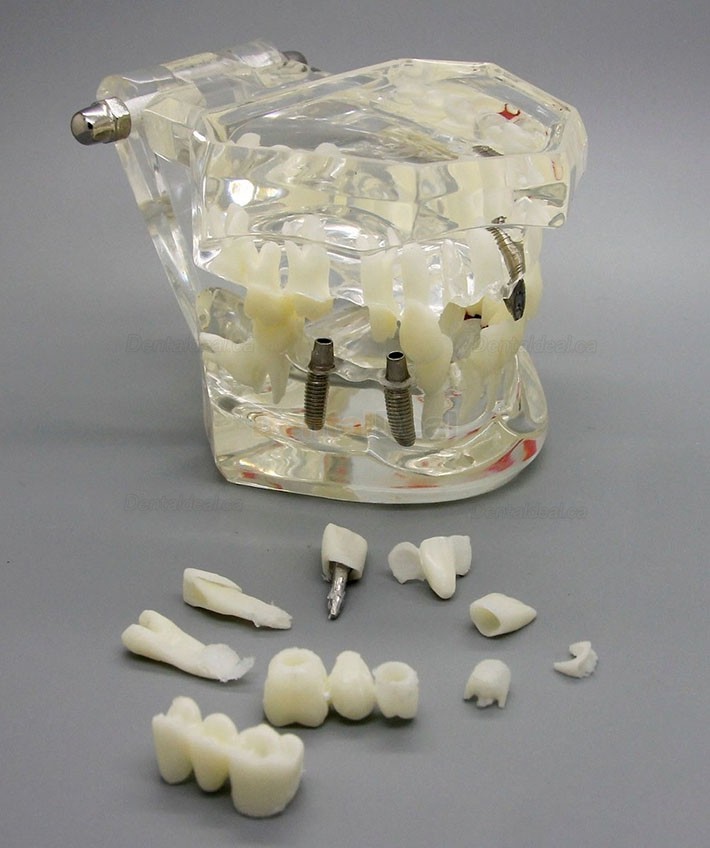 Dental Implant Study Demonstration Teeth Disease Model with Restoration for Students