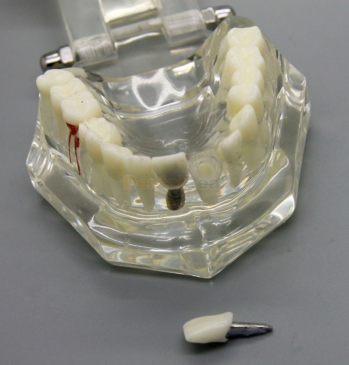 Dental Implant Study Demonstration Teeth Disease Model with Restoration for Students