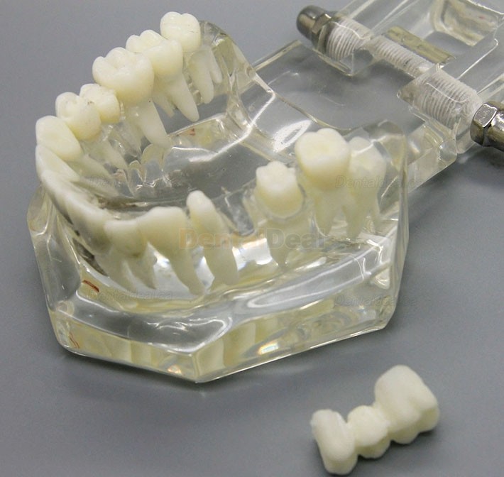 Dental Implant Study Demonstration Teeth Disease Model with Restoration for Students