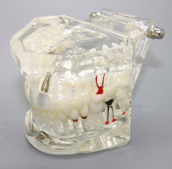 Dental Implant Study Demonstration Teeth Disease Model with Restoration for Students