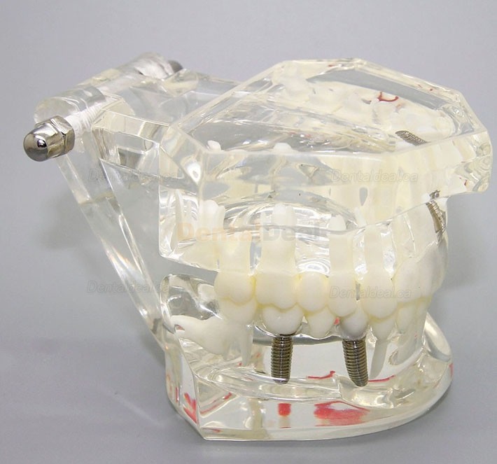 Dental Implant Study Demonstration Teeth Disease Model with Restoration for Students