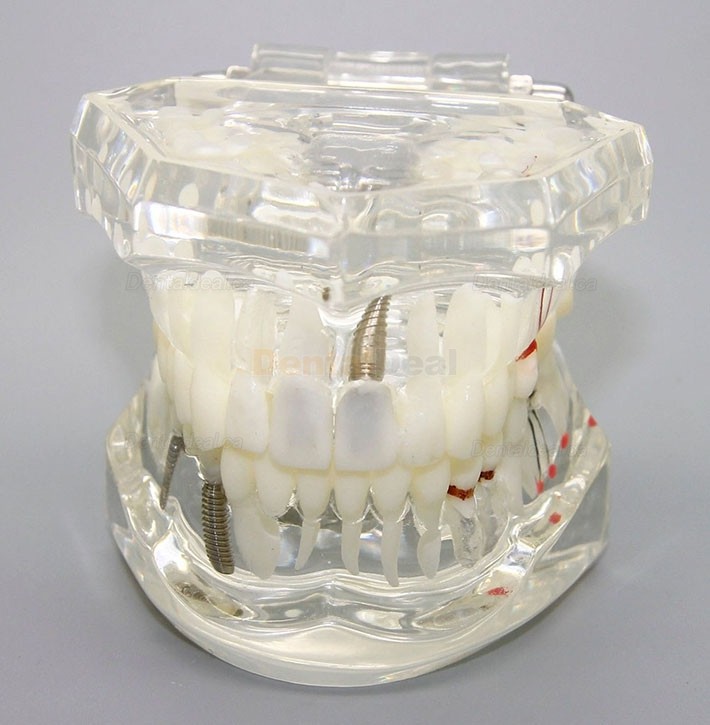Dental Implant Study Demonstration Teeth Disease Model with Restoration for Students