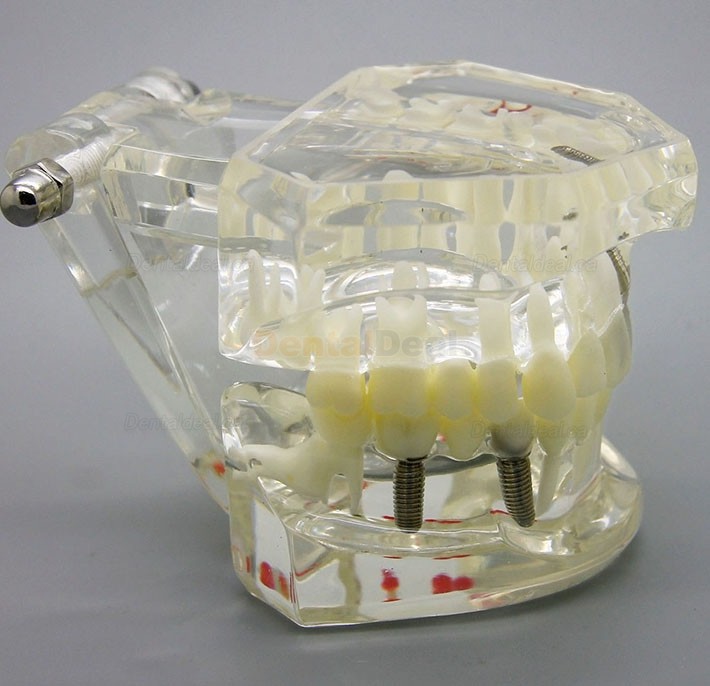 Dental Implant Study Demonstration Teeth Disease Model with Restoration for Students