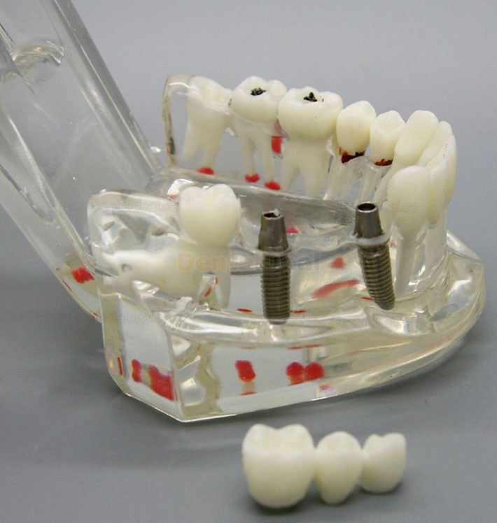 Dental Implant Study Demonstration Teeth Disease Model with Restoration for Students