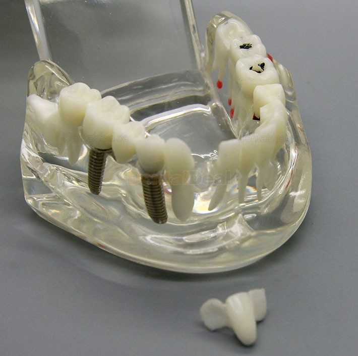 Dental Implant Study Demonstration Teeth Disease Model with Restoration for Students