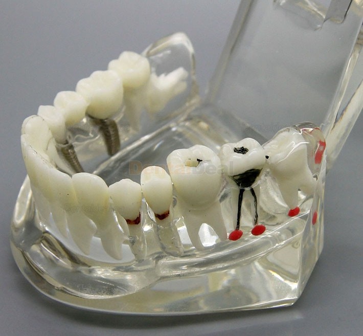 Dental Implant Study Demonstration Teeth Disease Model with Restoration for Students